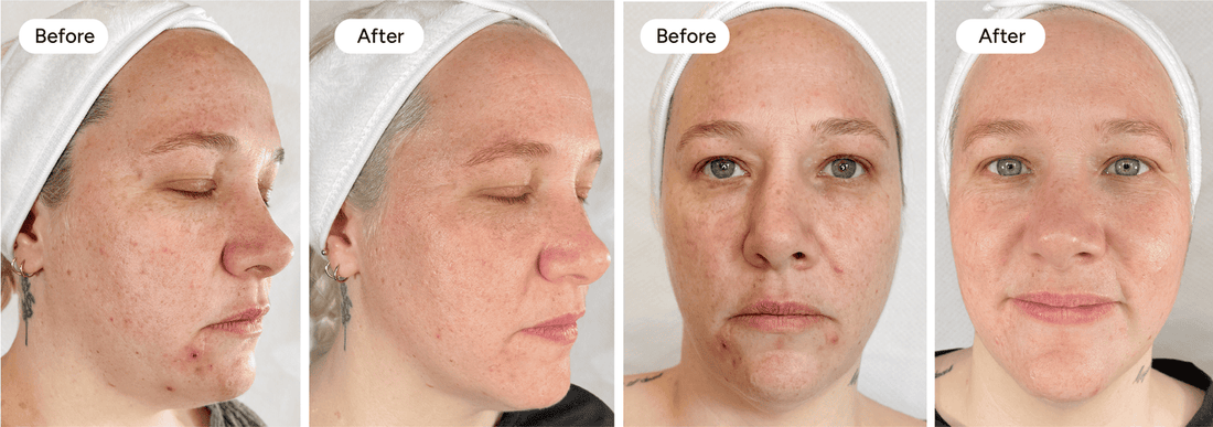 How Long Does Micro Infusion Take to Work? The Real Results Timeline