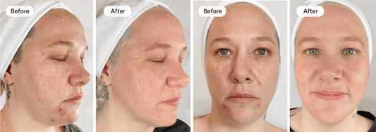 How Long Does Micro Infusion Take to Work? The Real Results Timeline