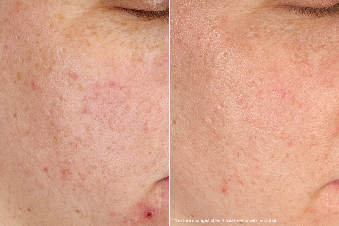 How I Finally Got My Skin Texture Under Control
