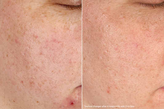 How I Finally Got My Skin Texture Under Control