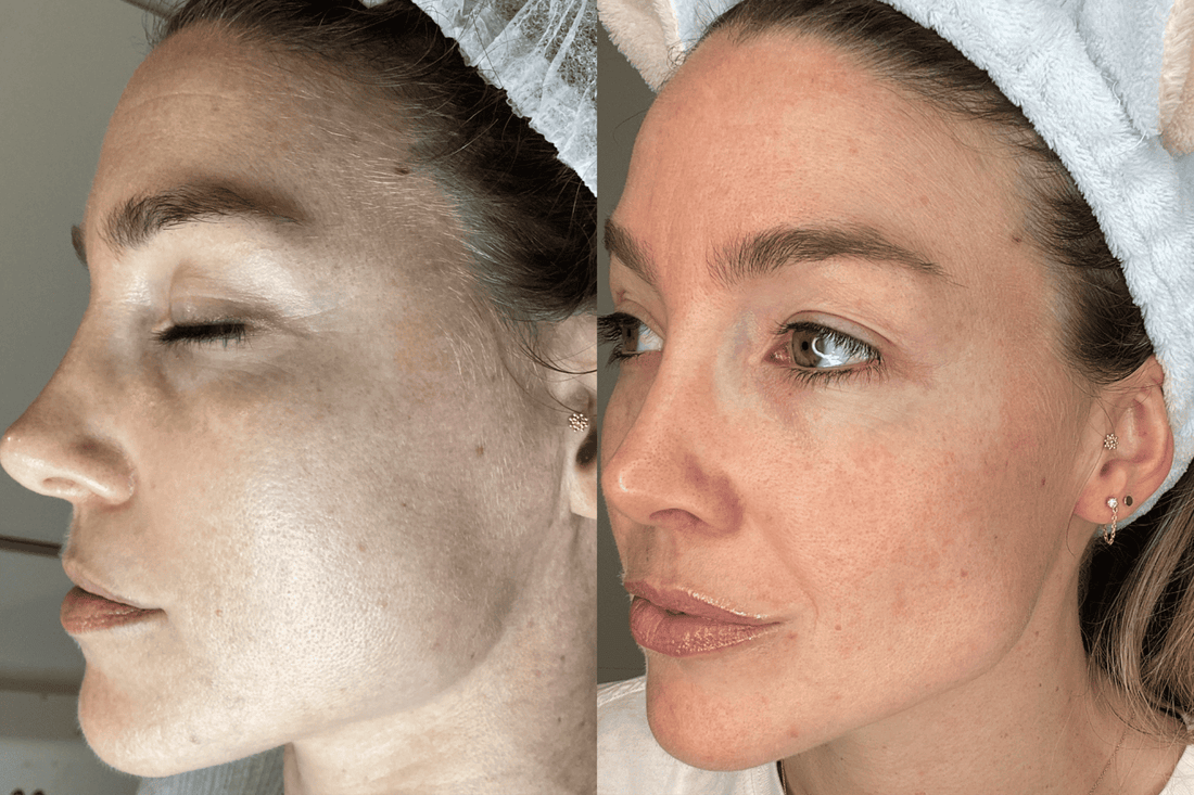 Why I Stopped Thinking About Botox (And What I Do Instead)