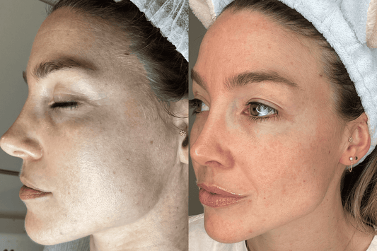Why I Stopped Thinking About Botox (And What I Do Instead)