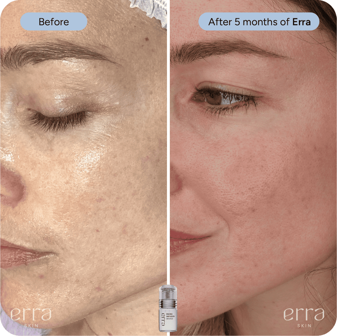 Micro Infusion Before and After: My Honest Results After 5 Months