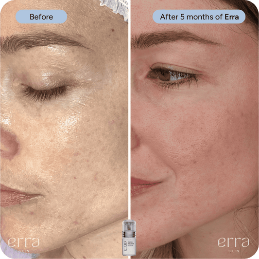 Micro Infusion Before and After: My Honest Results After 5 Months