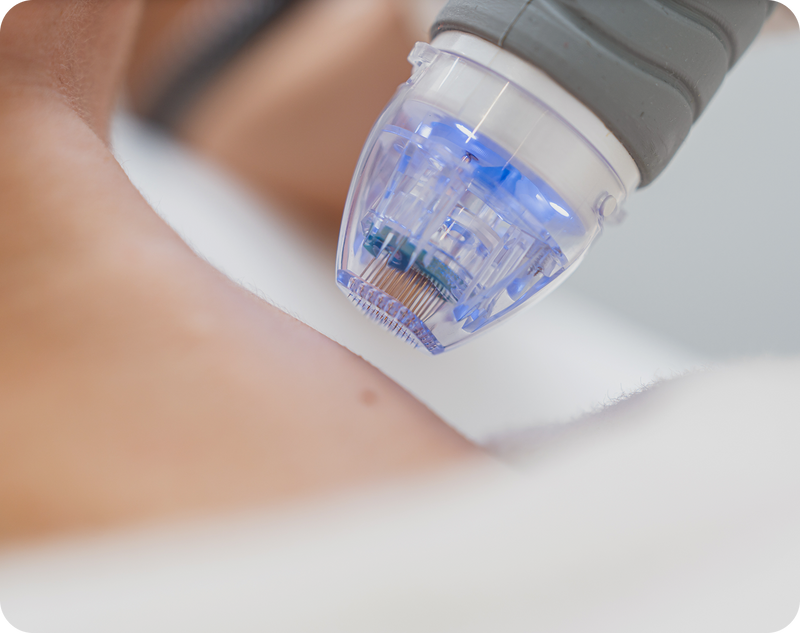 <p>Percutaneous collagen induction therapy: an alternative treatment for scars, wrinkles, and skin laxity</p>