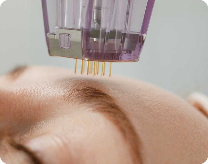 <p>Microneedling: A Review and Practical Guide</p>