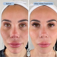 Micro Infusion Kit (Multi Peptide Serum)