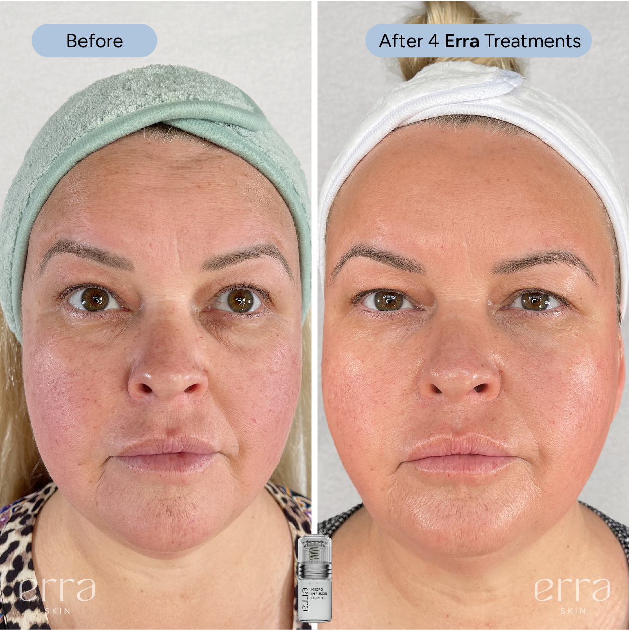 Micro Infusion Kit (Multi Peptide Serum)