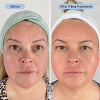 Micro Infusion Kit (Multi Peptide Serum)