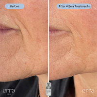 Micro Infusion Kit (Multi Peptide Serum)