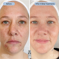 Micro Infusion Kit (Multi Peptide Serum)