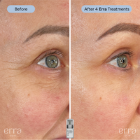 Micro Infusion Kit (Multi Peptide Serum)