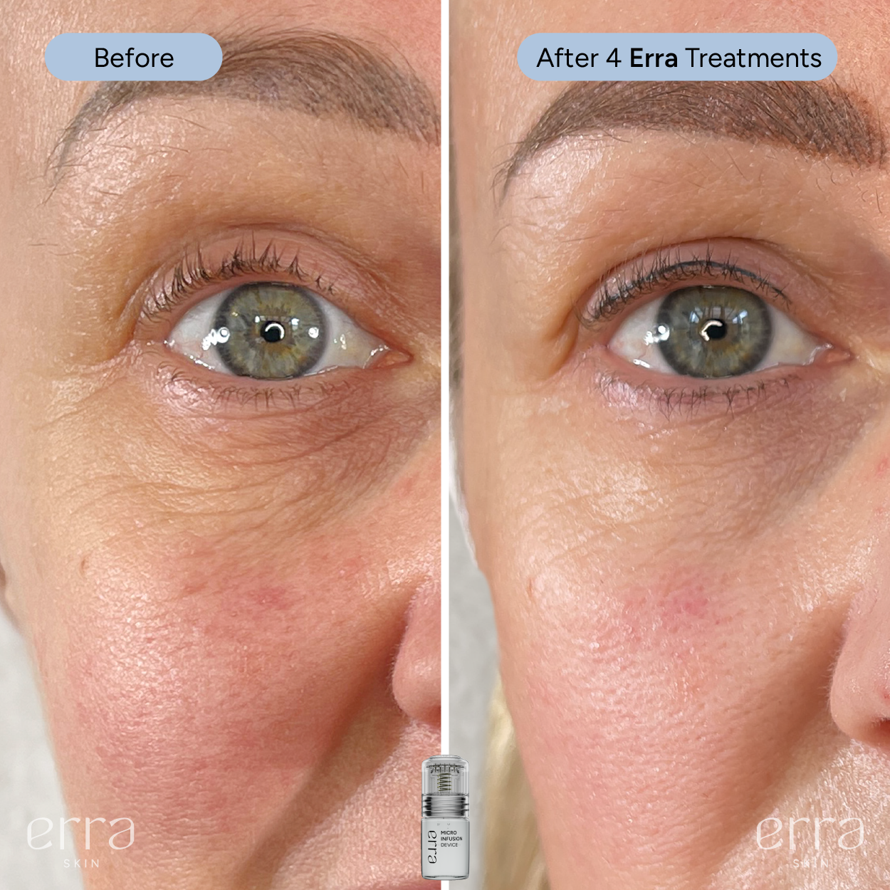 Micro Infusion Kit (Multi Peptide Serum)