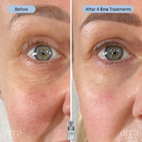 Micro Infusion Kit (Multi Peptide Serum)